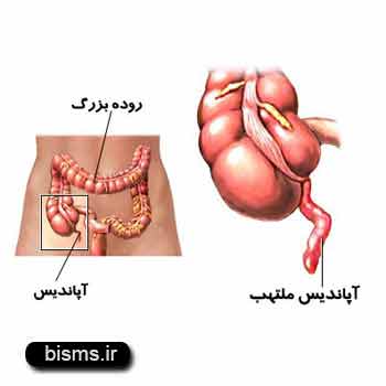 آپانديسيت،درمان آپانديسيت،آپانديسيت+علائم آپانديسيت،درمان آپانديسيت،آپانديسيت+علائم