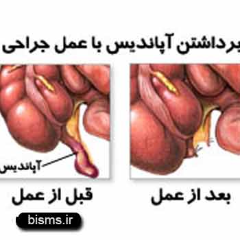 آپانديسيت،درمان آپانديسيت،آپانديسيت+علائم آپانديسيت،درمان آپانديسيت،آپانديسيت+علائم