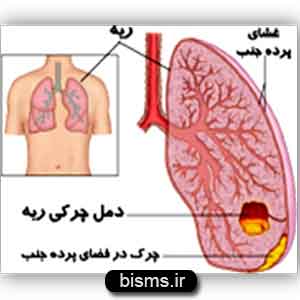 آمپیم,درمان آمپیم آمپیم,درمان آمپیم