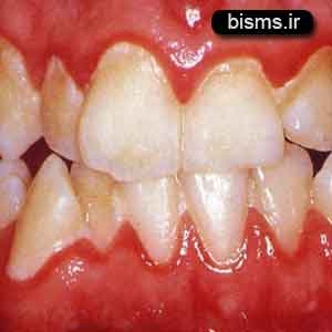 تغییر رنگ لثه تغییر رنگ لثه