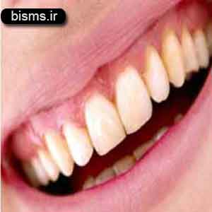 تغییر رنگ لثه نشانه چیست تغییر رنگ لثه نشانه چیست